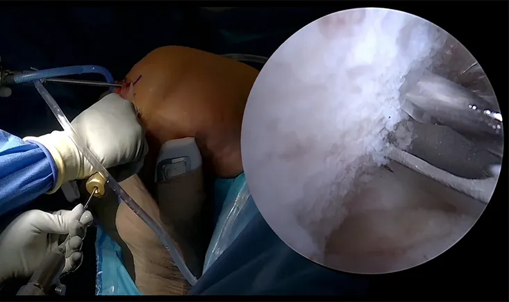 BTB Autograft ACL Reconstruction: why technique matters | Virtual fellowship with Jorge Chahla