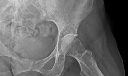 Management of hip pain in a 68 year-old woman