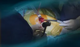 Minimally invasive posterior total hip replacement