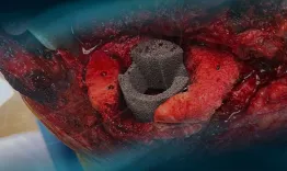 Combining allograft and tantalum cone to manage segmental metaphyseal tibial bone loss in revision TKA