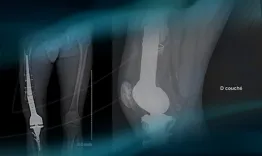 Metaphyseal break of a custom-made massive knee prosthesis 