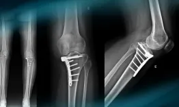 Management of a knee instability after ski trauma in a young woman