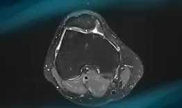 Management of chondral ‘kissing’ lesion of patella and trochlea