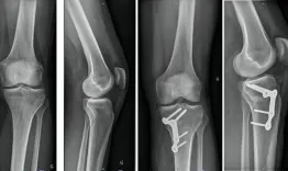 High tibial osteotomy, how to deal with the gap?
