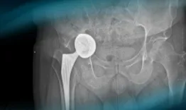 Management of an acetabular cup loosening with severe bone loss