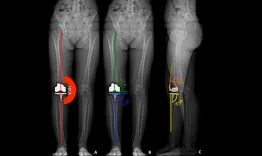 Space in flexion, space in extension. What does that mean?