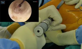 Knee anterolateral ligament reconstruction with a knotless soft anchor