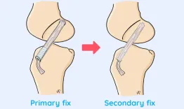 Biological failure of the ACL graft