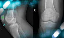 Management of a postoperative persistent patellofemoral instability in a young athlete