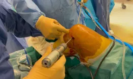 Revision PCL reconstruction