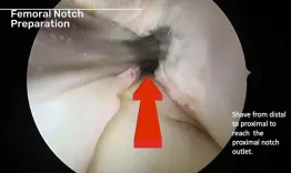Anatomical inside-out remnant preserving anterior cruciate ligament recontsruction: an optimal surgical technique for biological ACL reconstruction