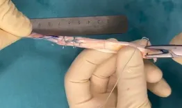 Rectus Femoris Tendon: A single autograft solution for combined anterior cruciate ligament and double-bundle anterolateral ligament reconstruction