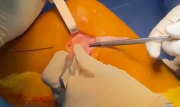 Lesions of the secondary stabilisers of the knee