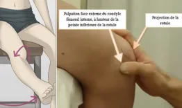 Knee osteochondritis dissecans