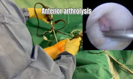 All-Arthroscopic anterior and posterior arthrolysis for extension deficit after ACL reconstruction