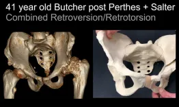 Arthroplasty in the Young Adult