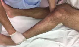 ACL revision - Concomitant Peripheral Instabilities