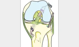 Football related ACL surgery to maximize outcome