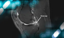 Medial meniscus root tear