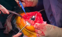 Onlay patellofemoral arthroplasty - Hermes, it couldn't be simpler