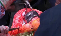 Showtime degenerative knee