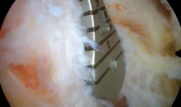 Trans septal approach for PCL Reconstruction