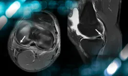 Ramp Lesion