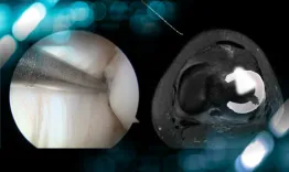 Radial tear