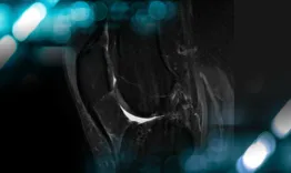 Management of an ACL graft failure done by Harmstrings