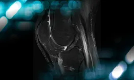 Management of a chronic multiligament knee injury
