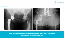 Excellence in hip research award: Pelvic tilt and cup position change significantly in most young patients 10 years after hip arthroplasty