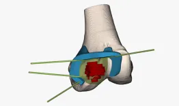 Surgical management of a subchondral cartilaginous tumor in the distal femur: resection and grafting technique