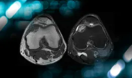 Management of an osteolytic lesion of the distal femur affecting the knee joint 