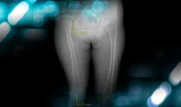 Management of a hip dysplasia in a middle-aged woman