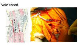 Posterolateral knee injuries: diagnosis, management and outcomes