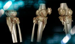 Management of a post fracture complicated leg deformity with a 30° tibial slope