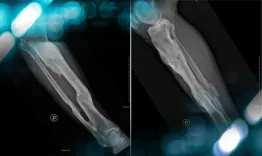 Management of Total Knee Arthroplasty in Post-Traumatic Malunion with Severe Deformity