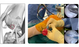 Post lateral corner injury management arthroscopic technique 