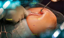 ACL Reconstruction Rectus Femoris Quad 2.0
