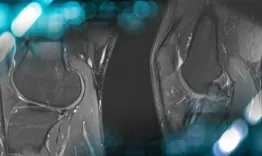 Re-revision ACL reconstruction plus meniscal transpalantation in a young patient