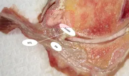 Medial ramp lesion: Pathophysiology and treatment