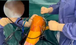 Flip-then-fill: Adjustable-loop pre-lengthening to facilitate button flipping before gaft passage in ACL reconstruction with femoral suspensory fixation