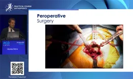 Acetabular bone loss treated with antiprotrusio cage