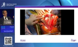 Extended Trochanteric Osteotomy (ETO): indications and surgical technique