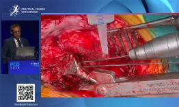 How to do a proper synovectomy in periprosthetic joint infection (PJI)?