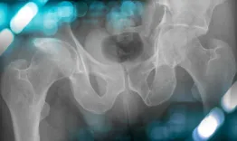 Management of a coxarthrosis secondary to a complex acetabular fracture
