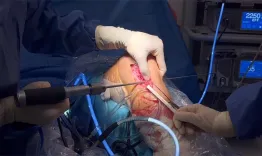 Rectus Femoris Tendon : A single continuous autograft for combined Anamatomic reconstruction of SMCL, dMCL and pol-a technical note