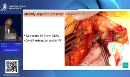 STAR approach for revision THA - The step-by-step technique