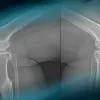 Post-traumatic knee pain: How to treat double varus deformity?