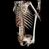 Bilateral girdlestone procedure